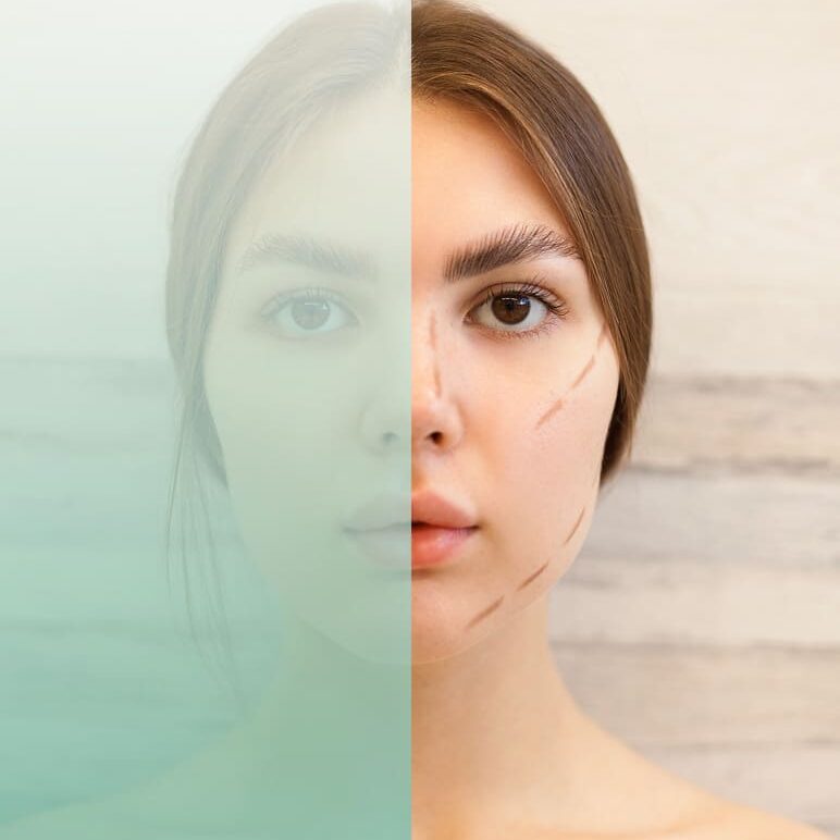 Нитевой лифтинг