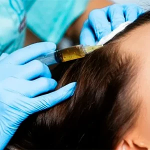 Плазмотерапия против выпадения волос (2)